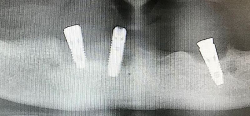 implantat